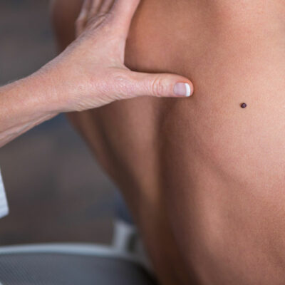 Major Risk Factors That Can Lead to Melanoma