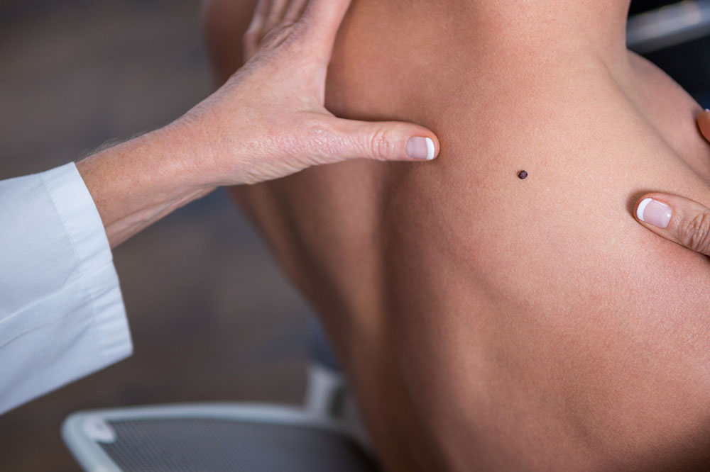 Major Risk Factors That Can Lead to Melanoma