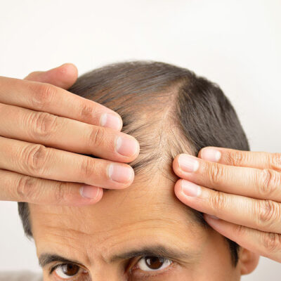 Hair Loss Prevention Tips for Men and Women