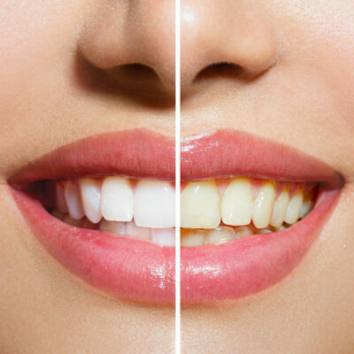 Top 6 Teeth Whitening Products for Effective Results