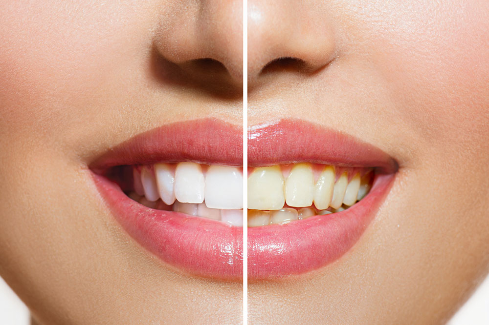 Top 6 Teeth Whitening Products for Effective Results